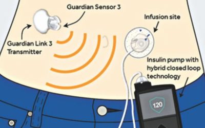 人工膵臓の治療は、1型糖尿病の血糖コントロールを改善する