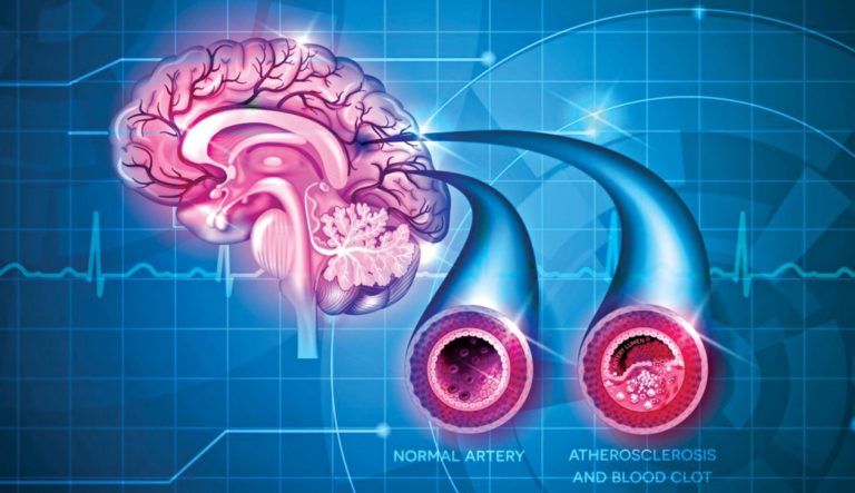 健康的な生活を奨励する世界脳卒中の日