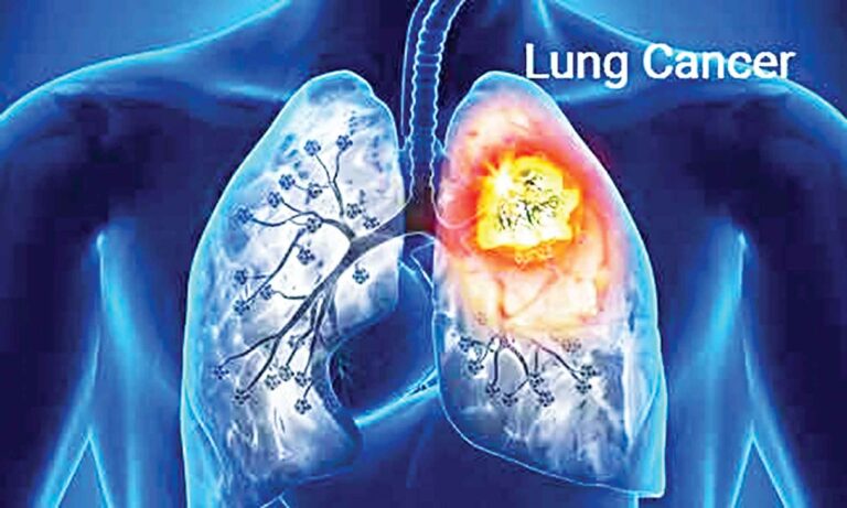 肺がんについて知る必要があるすべて