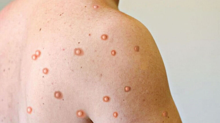 自分自身や他の人を MPOX から守るにはどうすればよいでしょうか?