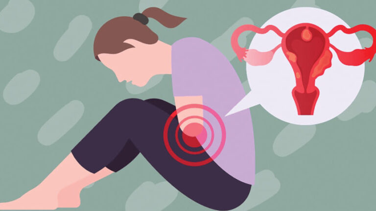 子宮内膜症：世界中で何百万人もの女性が罹患している一般的な病気