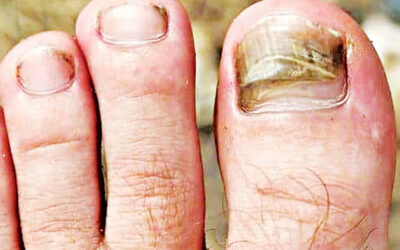 小さなひび割れが危機に：巨大爪感染症の真実