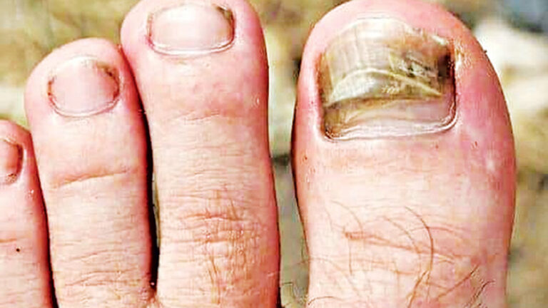 小さなひび割れが危機に：巨大爪感染症の真実