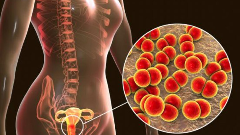 薬剤耐性淋病に対する単回投与薬の有効性