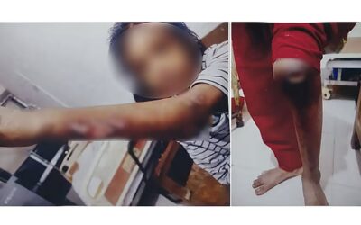 体は火傷で覆われ、ホットロッドの焼き印がそこら中に押されている