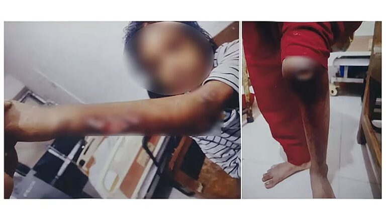 体は火傷で覆われ、ホットロッドの焼き印がそこら中に押されている