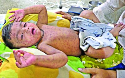 麻疹の症状でさらに5人が24時間以内に死亡