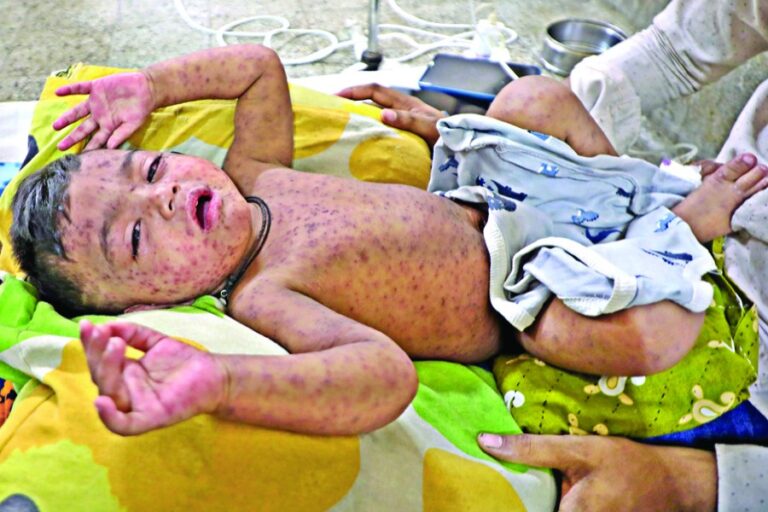 麻疹の症状でさらに5人が24時間以内に死亡